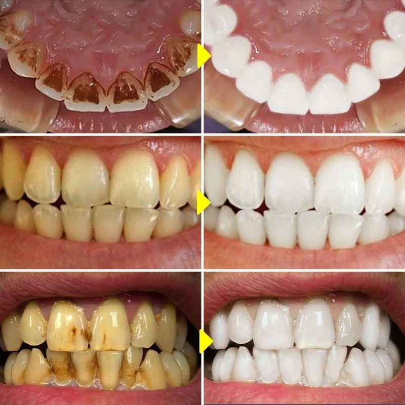 Teeth Whitening Toothpaste
